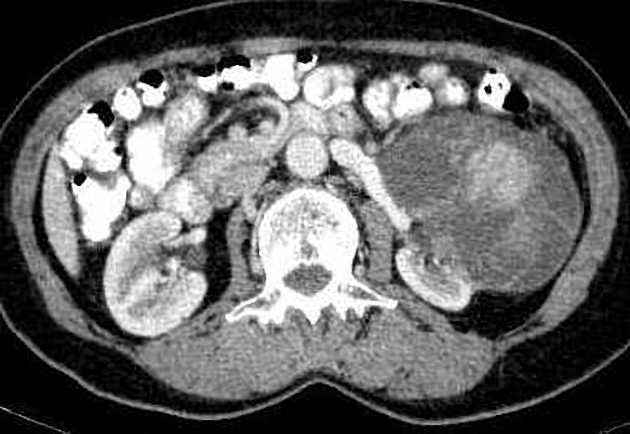 Tumor renal izquierdo